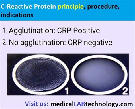 c-reactive protein test procedure | C reactive protein, Protein, Blood test