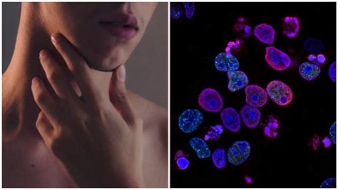 Study Shows Engaging In Oral Sex Can Lead To Throat Cancer