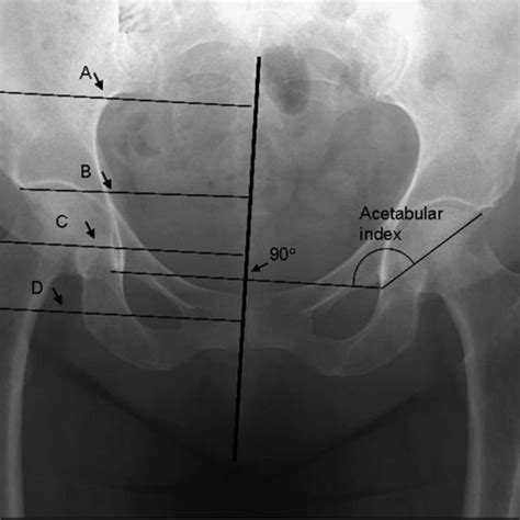 Morphology Measures Of The Pelvis Acetabular Index Neck Shaft Angle