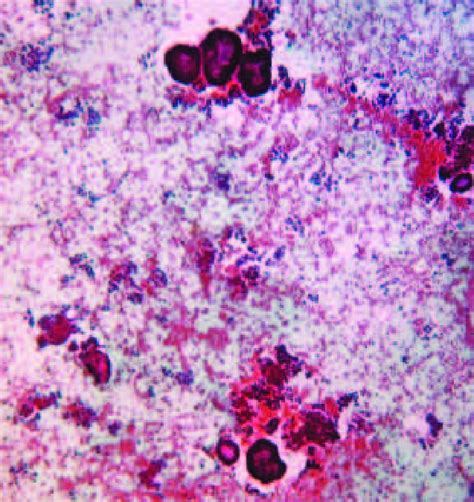 Ascitic fluid cytology showing cohesive clusters and papillary... | Download Scientific Diagram