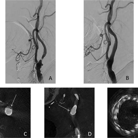 A Lateral View Of The Left Common Carotid Angiogram Shows Severe