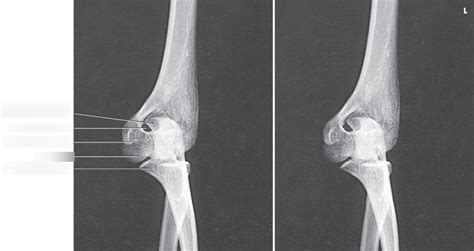 AP Oblique Elbow Medial Rotation Diagram Quizlet