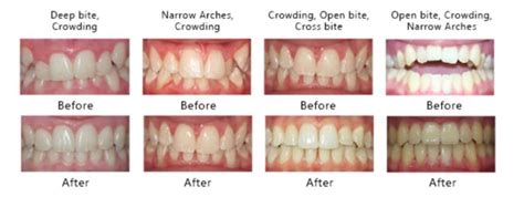 Invisible Braces - Crosspoint Dentistry