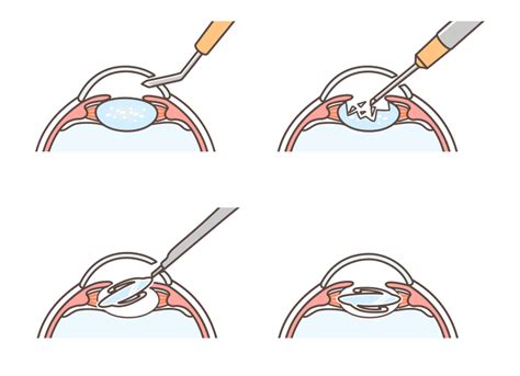 Cataract Surgery Philadelphia Restore Clarity Advanced Cataract Surgery Options