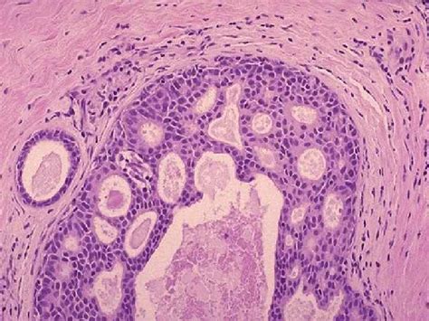 Epithelial tumors Lecture Epithelial tumors etiology