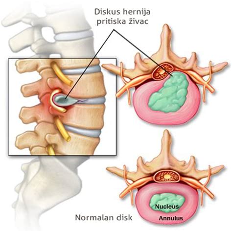 Diskus hernija LIJEČENJE UZROCI SIMPTOMI I DIJAGNOZA