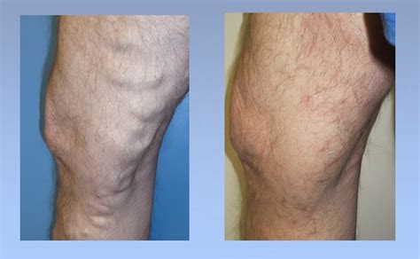 Before After Varicose Veins Miller Vein Miller Vein