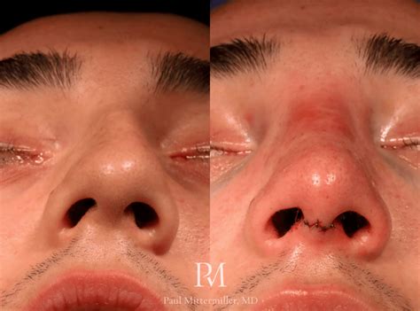 Septoplasty Only Before And After