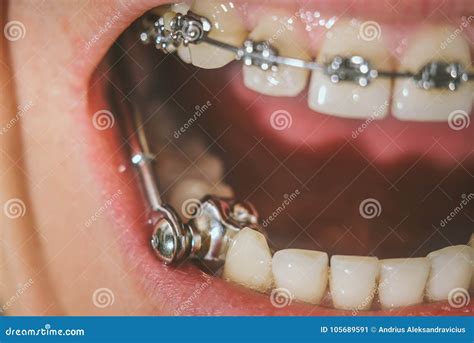 Dental Appliance and Braces Stock Image - Image of overjet, beauty ...