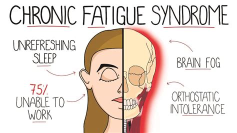 Chronic fatigue syndrome – symptoms, causes and management ...