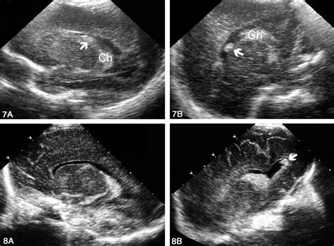 Posterior Fontanelle Sonography An Acoustic Window Into The Neonatal