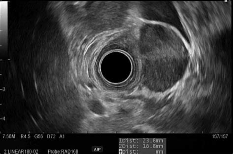 Endoscopic Ultrasound In Duodenal Bulb Showed A 23 8 Mm × 16 8 Mm Download Scientific Diagram