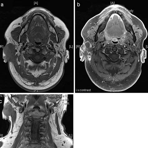 A Preoperative Magnetic Resonance Imaging Mri Axial Section Tra Tse