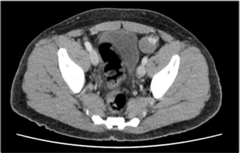 Figure 1 From Torsion Of An Intra Abdominal Testis Presenting As Acute