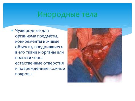 Доброкачественные опухоли средостения. Казуистика травм пищевода ...