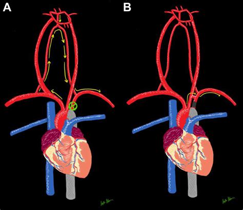 Subclavian Steal Syndrome