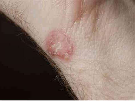 Things That Increase Risk Of Getting Fungal Infections