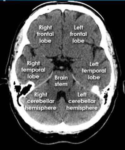 CT Head Flashcards Quizlet