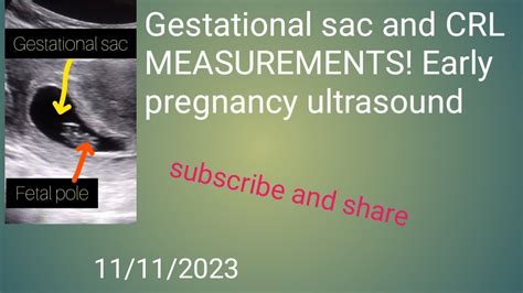 Gestational Sac And Crl Measurements On Ultrasound Pregnancy