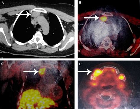 Giant Mediastinal Parathyroid Adenoma Presenting As Bilateral Brown Tumour Of Mandible A Rare