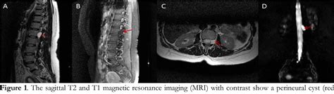 Figure 1 From Perineural Tarlov Cyst Mimicking Lumbar Radiculopathy