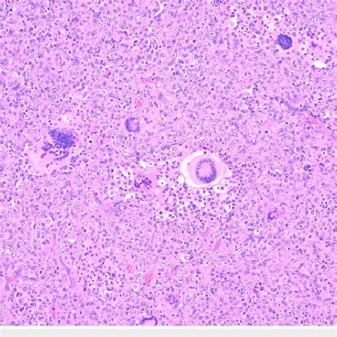 Giant Touton Like Histiocytes Comprised Of Multinucleated Cells