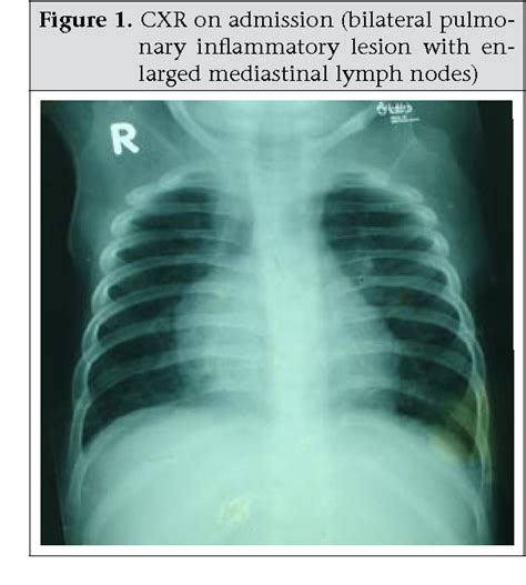 Figure From Interstitial Lung Disease And Profound Hypoxaemia In A