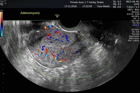 Pelvic Scan Private Ultrasound Scans London