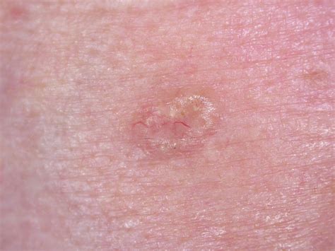 Basal Cell Carcinoma Bcc Dr Jonathan Bowling