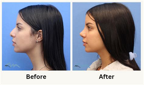 Rhinoplasty Miami Nose Job Surgeon Miami Plastic Surgery