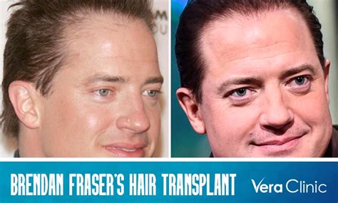 Brendan Fraser Hair Transplant