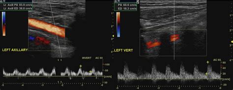 Subclavian Artery Ultrasound