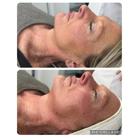 Skin Base Collagen Lift Aesthetics The Pink Room