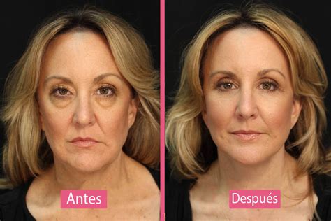 Blefaroplastia Inferior ¡recomendaciones Y Guía 【2019】