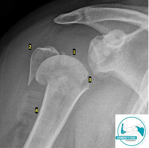 Fractura Del Húmero Proximal Cirujano Hombro And Codo