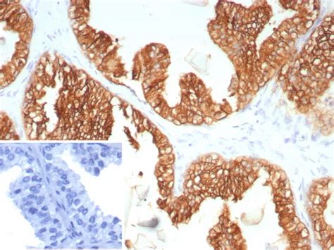 Cytokeratin 5 6 Basal Myoepithelial Mesothelial Cell Marker