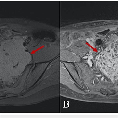 T1 Weighted Fat Saturated Axial A And Contrast Enhanced Axial B Mri