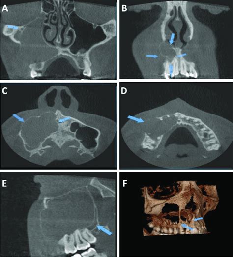 Cone Beam Computed Tomography Cbct Scans Of The Radicular Cyst In The Download Scientific