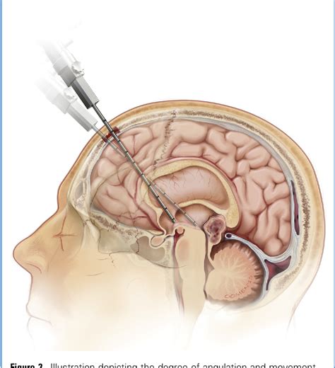 Figure 2 From Endoscopic Third Ventriculostomy Outcome Analysis Of An Anterior Entry Point