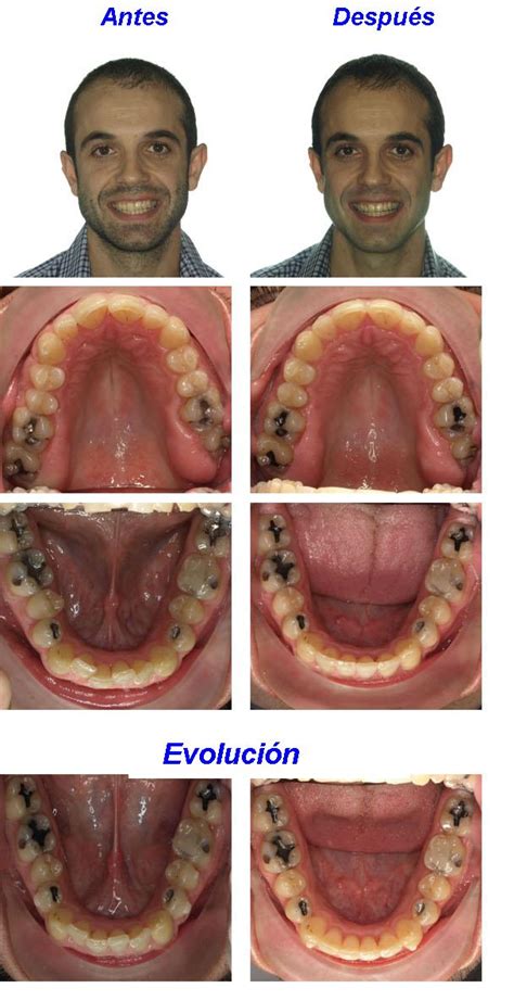 Apiñamiento Invisalign Ortodoncia Moliner Zaragoza