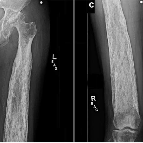 Preoperative Anteroposterior A And Lateral B Radiographs Of The