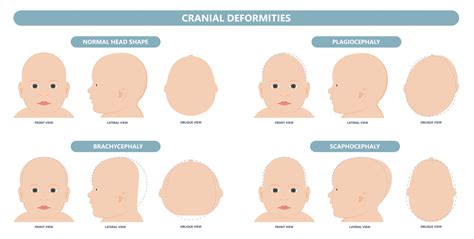 Lets Talk Head Shape — Active Health Riverina Physiotherapy