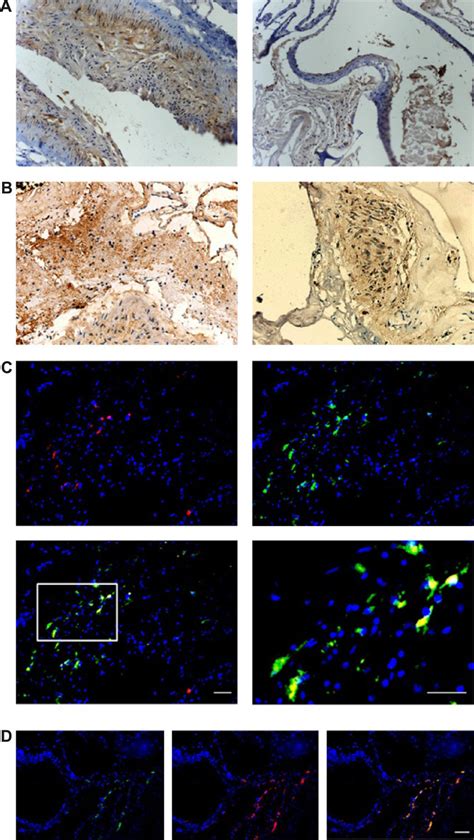 Sdf And Cxcr Expression In Avm Lesions Notes A Ihc Staining Of