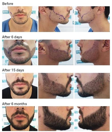 Hair Transplant In Gurgaon Hair Transplant Growing A Full Beard