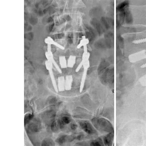 Postoperative Ap And Lateral Radiographs Demonstrating Implant Position