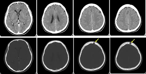 Lytic Skull Metastasis Radiology Cases