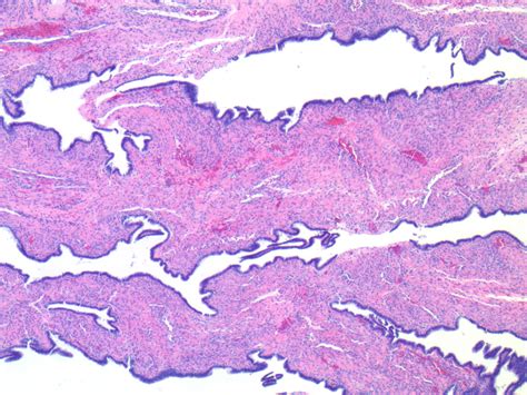 Serous Cystadenoma Ovary Histology