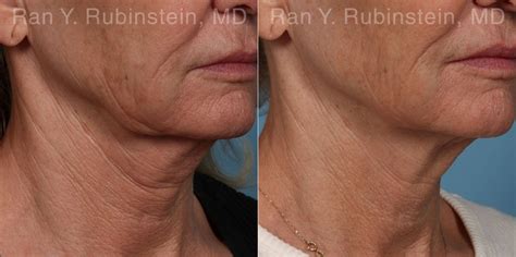 Rf Microneedling Neck Before And After Edu Svet Gob Gt