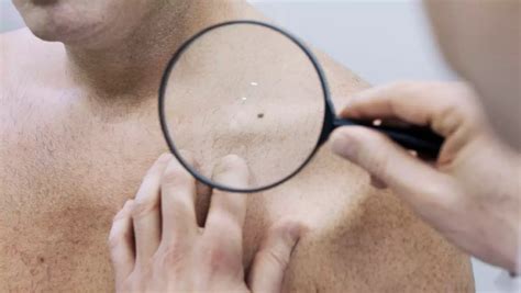 How To Spot Actinic Keratosis Early A Guide For Self Examination