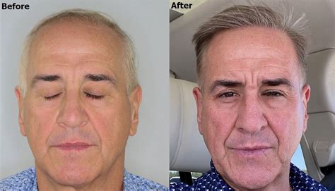 3 500 Grafts FUE PRP Alvi Armani Hair Transplant Los Angeles